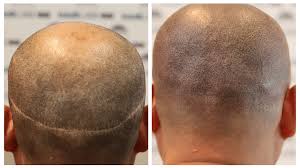 Scalp Micropigmentation