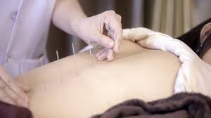 Acupuncture