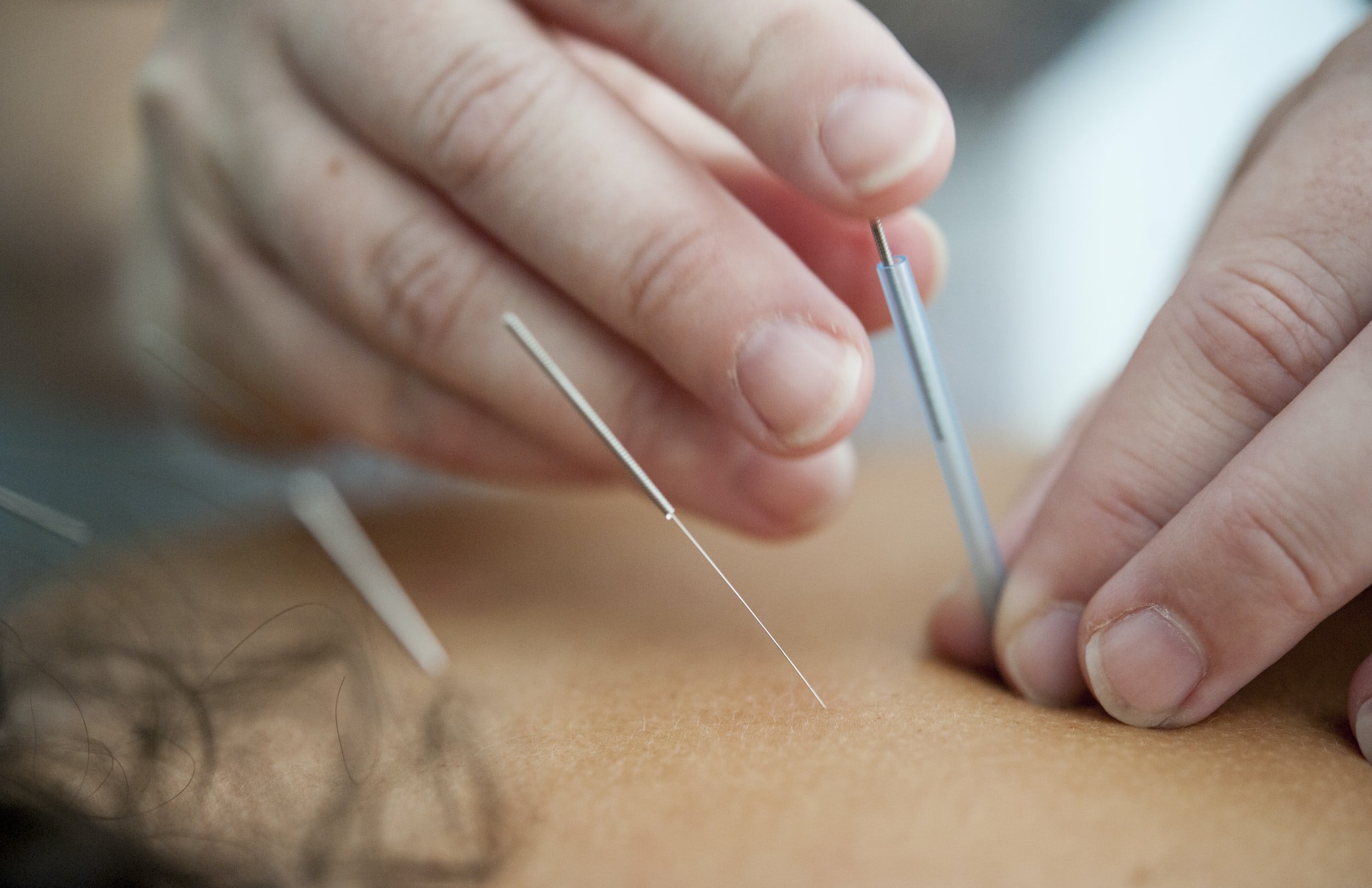 fertility acupuncture Melbourne