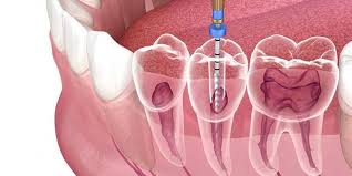 root canal Newtown