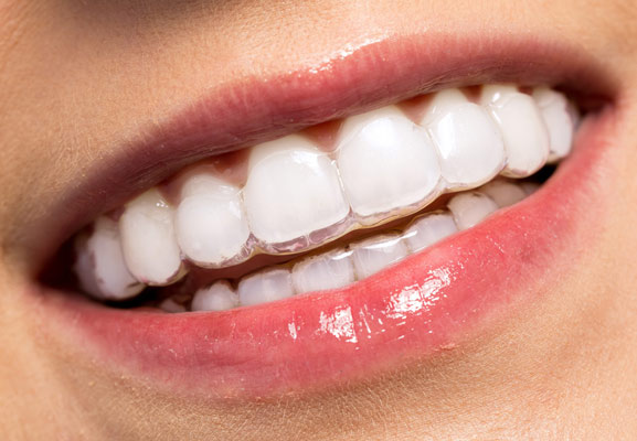 Invisalign dentist Paddington