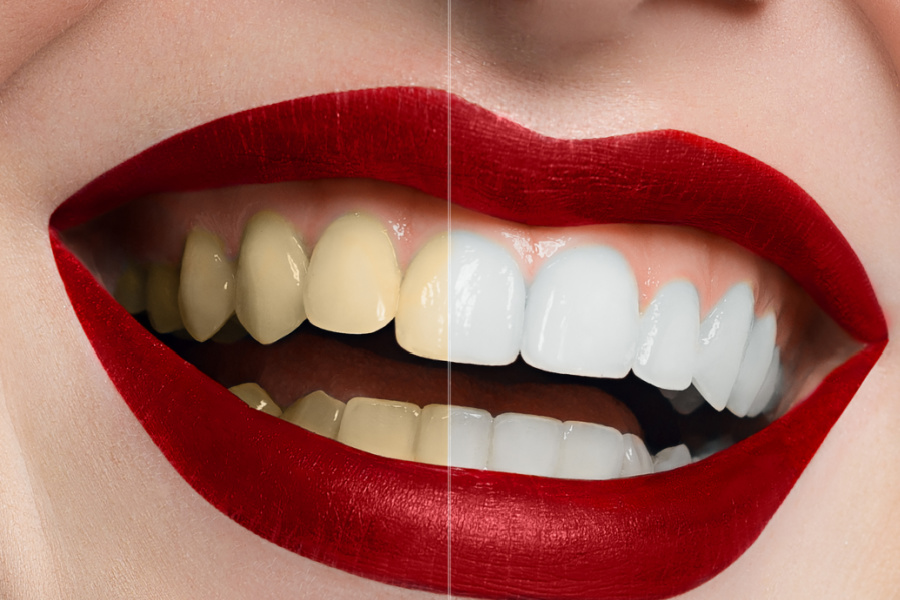 teeth whitening Christchurch