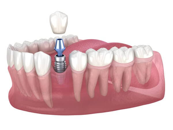 dental implants Newtown